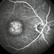 Macular Dystrophy FA Macular Dystrophy FA