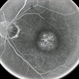 Macular Dystrophy FA Macular Dystrophy FA