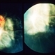 Toxocara Canis