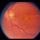 Pattern Dystrophy