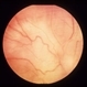 Toxocara Canis