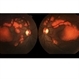 Polymorphous Vitelliform Maculopathy Polymorphous Vitelliform Maculopathy