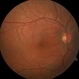 Solar Retinopathy
