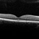 Solar Retinopathy