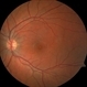 Solar Retinopathy