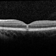 Solar Retinopathy