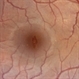 Solar Maculopathy Solar Maculopathy