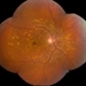 Stargardt Disease Stargardt Disease