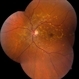 Stargardt Disease Stargardt Disease
