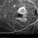 Stargardt's Disease Stargardt's Disease
