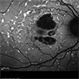 Stargardt's Disease Stargardt's Disease