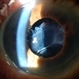 Subluxated Crystalline IOL With Pseudoexfoliation (1)