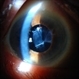 Subluxated Crystalline IOL With Pseudoexfoliation (3)
