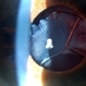 Subluxated Crystalline IOL With Pseudoexfoliation