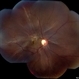 Traumatic Macular Hole with Retinal Detachment and PVR - montage