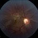 Traumatic Macular Hole with Retinal Detachment and PVR