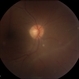 Syphilitic Panuveitis, Right Eye