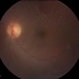 Syphilitic Panuveitis, Left Eye