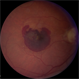 Macular Degeneration with Large Submacular Hemorrhage