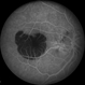 Macular Degeneration with Large Submacular Hemorrhage