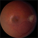 Macular Degeneration with Large Submacular Hemorrhage