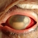 Endophthalmitis Endophthalmitis