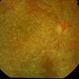 Triamcinolone in vitrectomised eye Triamcinolone in vitrectomised eye