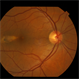 Torpedo Maculopathy 1 Torpedo Maculopathy 1