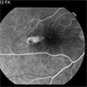 Torpedo Maculopathy 3 Torpedo Maculopathy 3