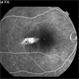 Torpedo Maculopathy 9 Torpedo Maculopathy 9