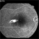 Torpedo Maculopathy 11 Torpedo Maculopathy 11