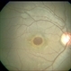 Traumatic Macular Hole Traumatic Macular Hole