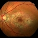 Target Lesion
