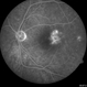 Telangiectasia Telangiectasia