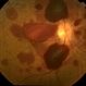 Terson Syndrome