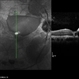 Terson Syndrome