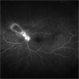 Toxoplasmosis Toxoplasmosis