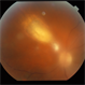Toxoplasmosis Toxoplasmosis