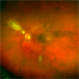 Toxoplasmosis Toxoplasmosis