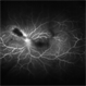 Toxoplasmosis Toxoplasmosis