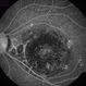Ocular Toxoplasmosis Scar, Fluorescein Angiogram Ocular Toxoplasmosis Scar, Fluorescein Angiogram