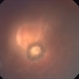 Toxoplasma Gondii Chorioretinitis Toxoplasma Gondii Chorioretinitis