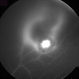 Toxoplasma Gondii Chorioretinitis, Fluorescein Angiogram Toxoplasma Gondii Chorioretinitis, Fluorescein Angiogram