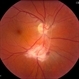 Toxoplasmosis Vitreoretinal Traction