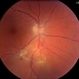 Toxoplasmosis Vitreoretinal Traction
