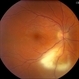 Toxoplasmosis Vitreoretinal Traction