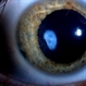 Traumatic Cataract