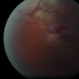 Choroidal rupture Subretinal and Vitreous Hemorrhage Secondary to Blunt Trauma Choroidal rupture Subretinal and Vitreous Hemorrhage Secondary to Blunt Trauma