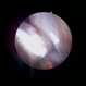 Aniridic Fibrosis Syndrome #6 of 7
