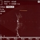 Optic Disc Drusen Optic Disc Drusen
